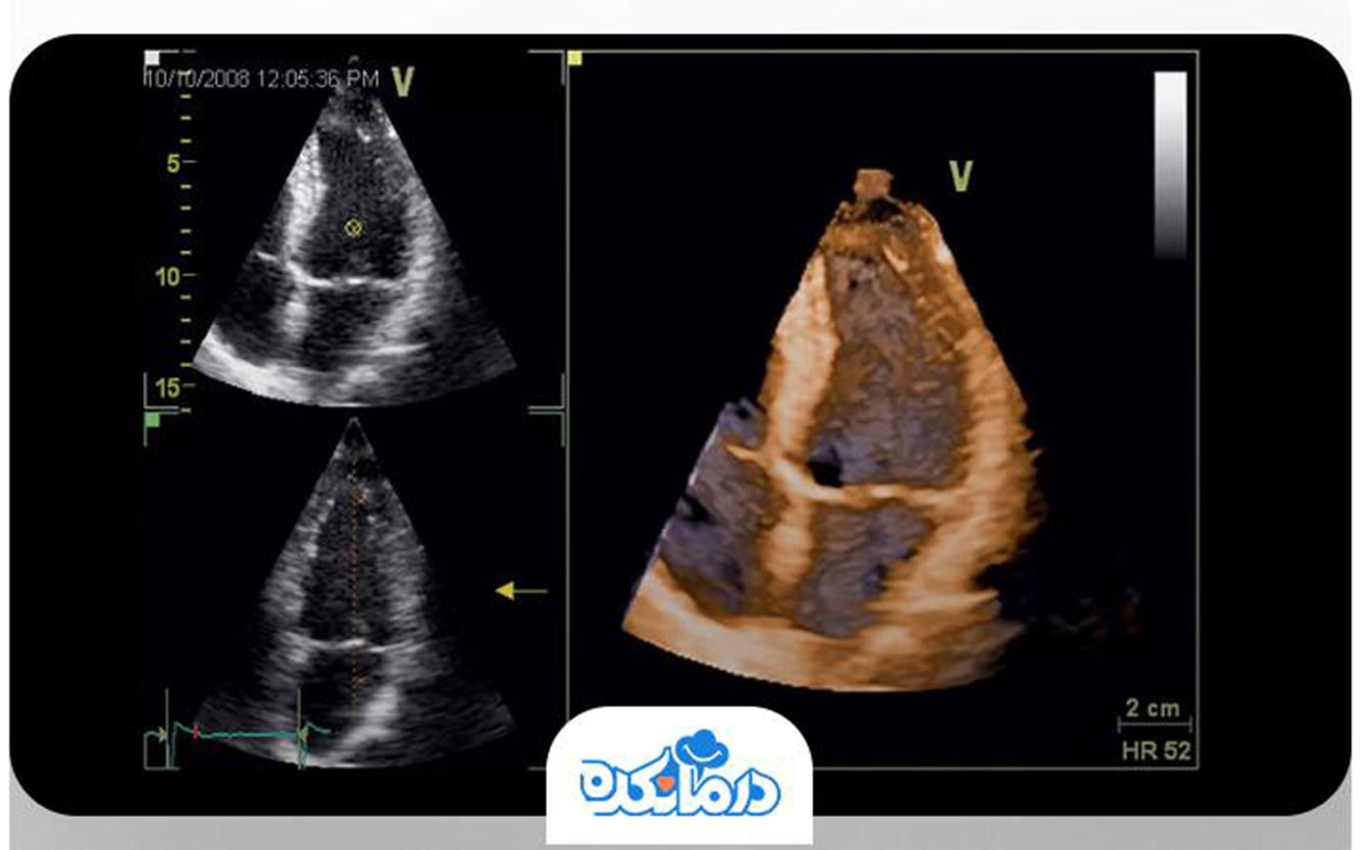 تصویری از اکوکاردیوگرافی قلب