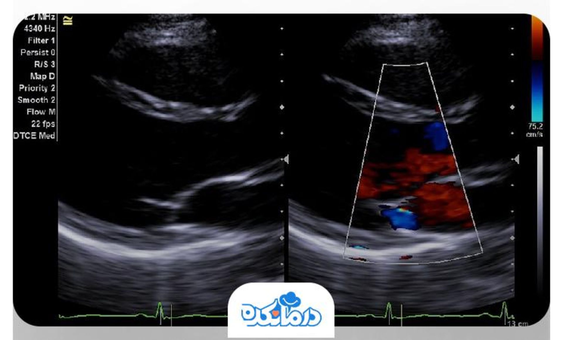 بیماری که روی تخت دراز کشیده و پزشک مشغول اکوکاردیوگرافی است